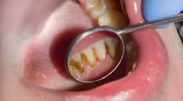 دون الحاجة للذهاب إلى الطبيب .. طرق طبيعية وآمنة للتخلص من جير الأسنان