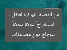 استخراج «شوكة سمكة» من القصبة الهوائية لطفل بـ سوهاج دون مضاعفات