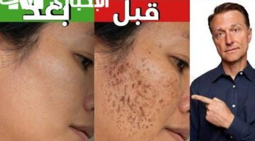 كل البقع راحت في ثانية.. وصفات للبشرة توحيد مضمون