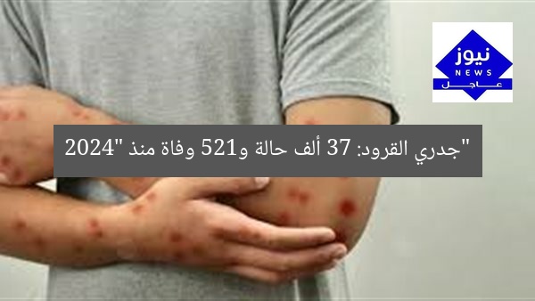 “جدري القرود: 37 ألف حالة و125 وفاة منذ 2024”