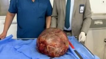 «استئصال ورم وزنه 40 كليو».. تفاصيل حراجة استمرت 6 ساعات في معهد ناصر