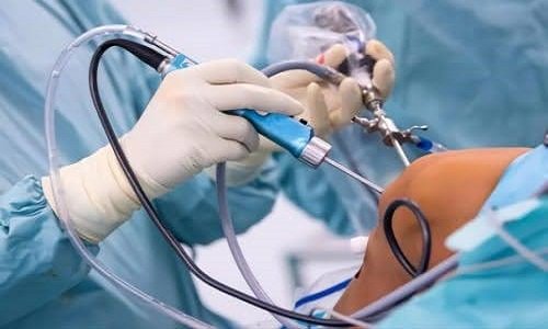 تكلفة عملية الرباط الصليبي بالمنظار في مصر 2025.. كيف تختار أفضل دكتور رباط صليبي؟