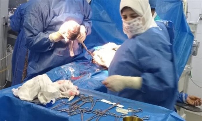 سيدة تضع 4 توائم في المنوفية