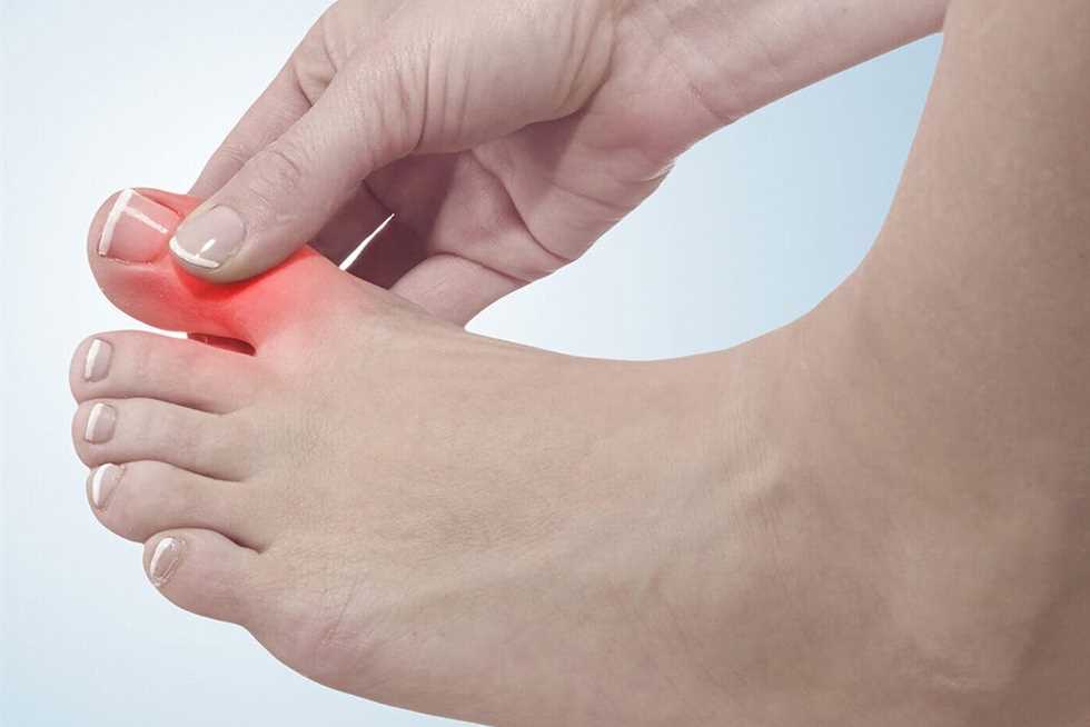 نوبات متقطعة من الألم.. ما هي علامات النقرس عند النساء؟