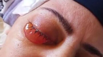 سيدة تفقد بصرها بعد جراحة لإزالة المياه الزرقاء بمستشفى رمد المحلة