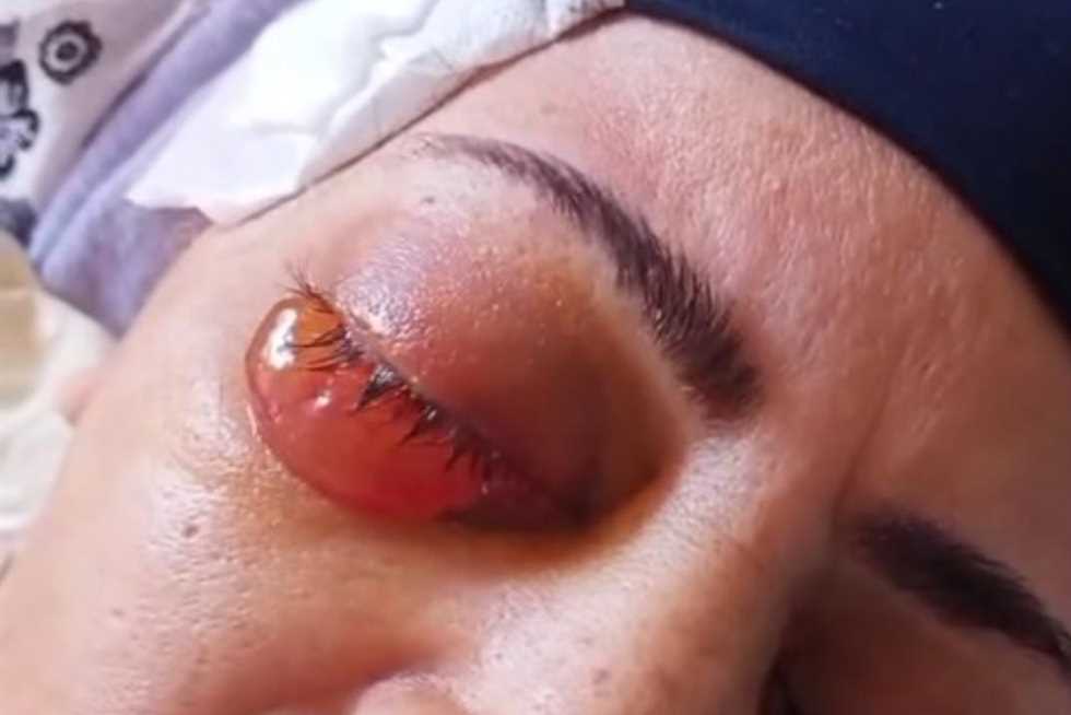 سيدة تفقد بصرها بعد جراحة لإزالة المياه الزرقاء بمستشفى رمد المحلة