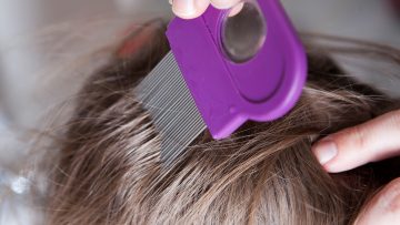 عاجل.. فطريات فروة الرأس… كيف تنتقل وما هي أعراضها؟