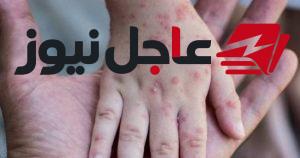 الصحة تطلق الحملة القومية مجاناً لتطعيم الأطفال من 9 شهور حتى 10 سنوات ضد الحصبة