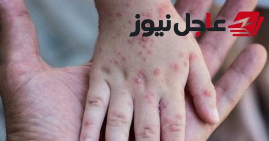 الصحة تطلق الحملة القومية مجاناً لتطعيم الأطفال من 9 شهور حتى 10 سنوات ضد الحصبة
